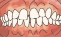・正中離開（せいちゅうりかい）、空隙歯列（くうげきしれつ）